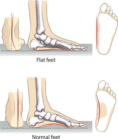 Flat vs Normal Feet