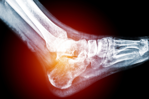 X-ray of heal