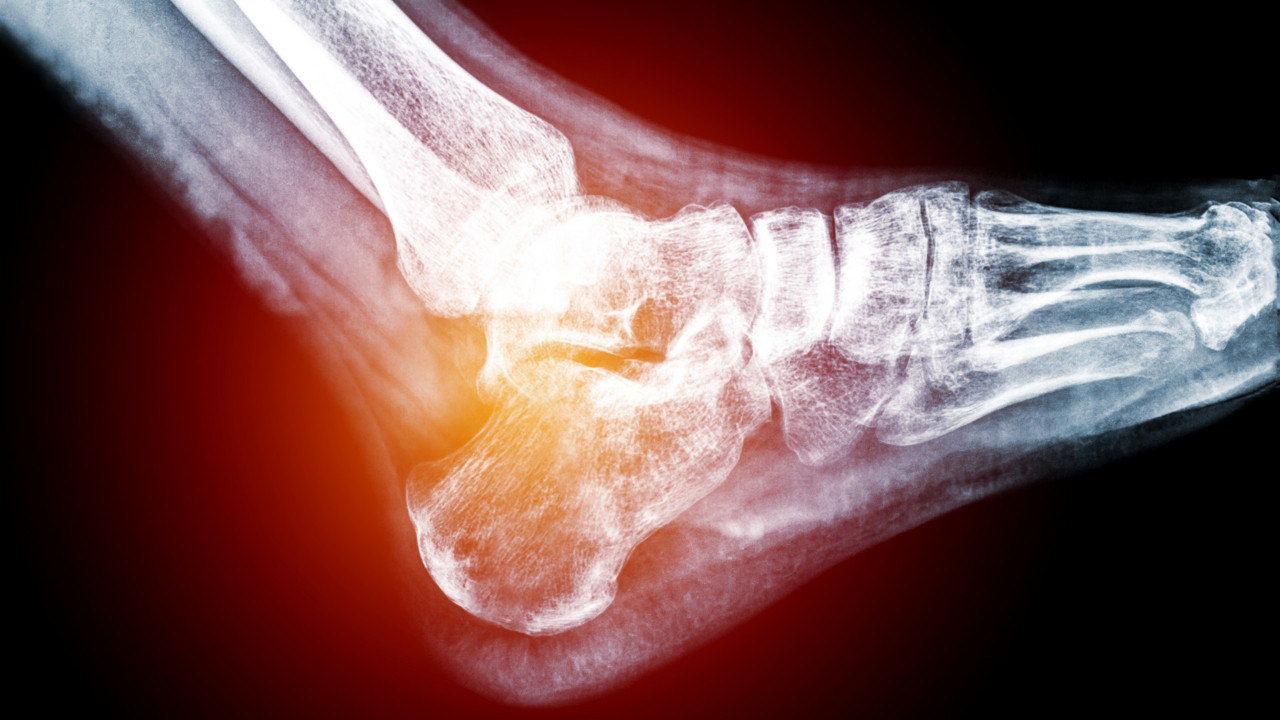 Plantar Fasciitis | Tennessee Orthopaedic Alliance