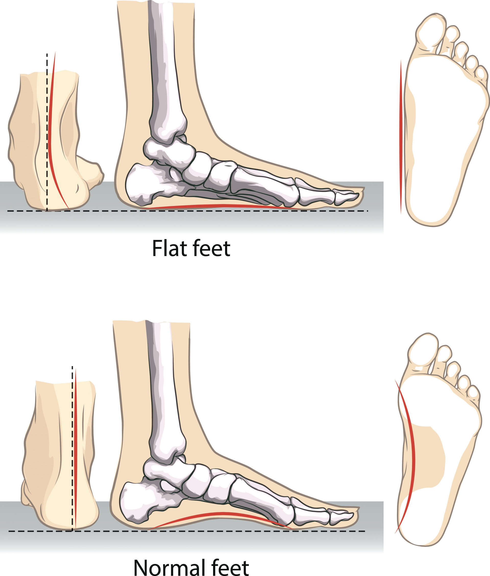 Falling Arches Adult Acquired Flatfoot Deformity Tennessee