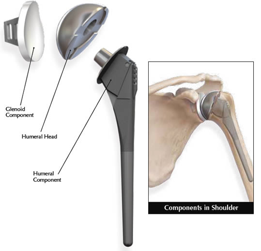 Shoulder Replacement FAQs | Tennessee Orthopaedic Alliance