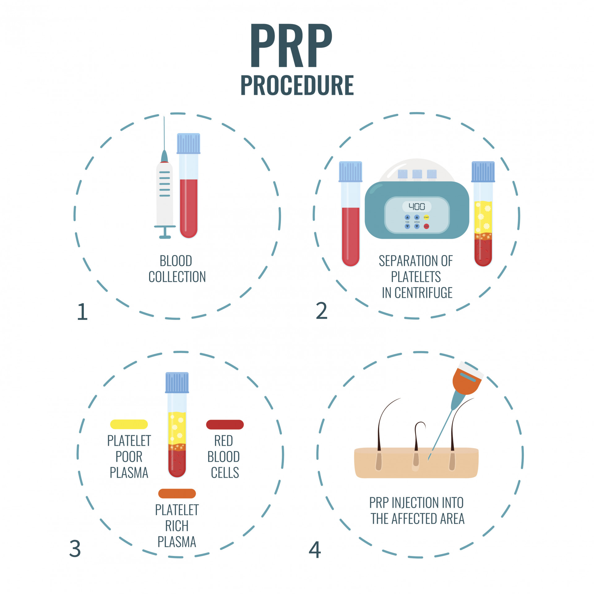 PRP Procedure