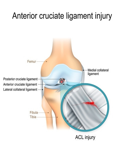 Anterior Cruciate Ligament (ACL) & Medial Collateral Knee Ligament